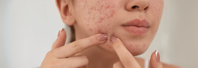 First-Ever Acne Vaccine Enters Clinical Trials; Could Clear Skin Be Just One Shot Away?