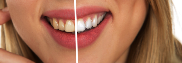 What Is ‘Ozempic Teeth’? Why ‘Ozempic Face’ Isn’t the Only Worry About the Weight-Loss Drug