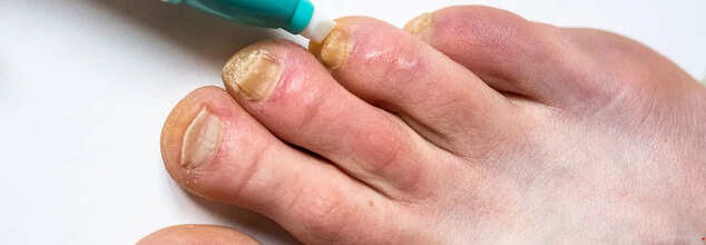 Infection Causing Fungal Infection Could Kill Millions