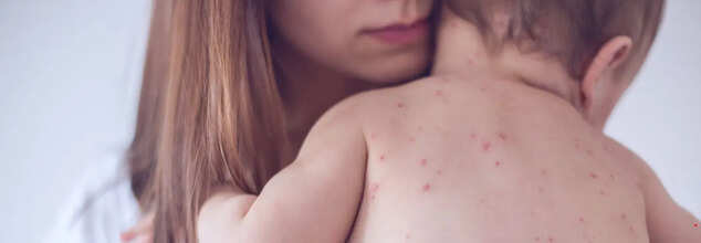 Canada Achieved Measles Elimination Status In 1998-It Could Soon Lose It