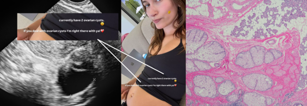 Hailey Bieber Is Battling With Ovarian Cysts, All That You Need To Know About It