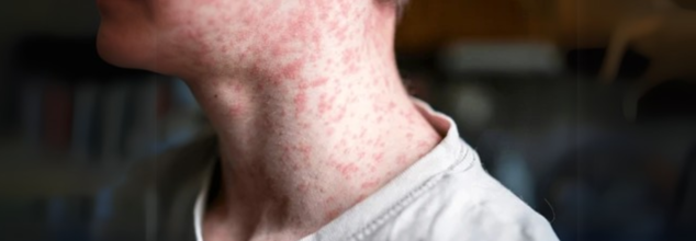 Measles Vaccination Rates Fall In US, Map Reveals Counties At High Risk For Outbreaks