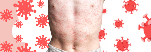 US Faces Biggest Measles Spike in Three Decades—What’s Driving the Surge?