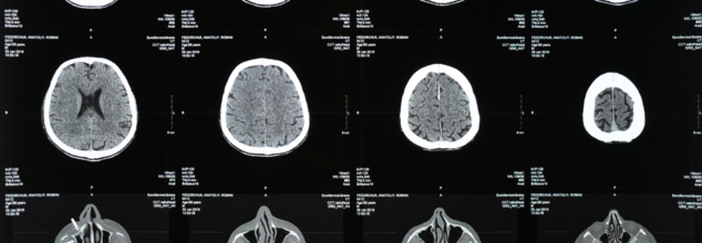 World Brain Tumor Day 2025