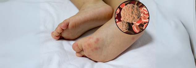 Invasive Meningococcal Disease Confirmed In Maldives; What Are The Symptoms Of This Bacterial Infection?