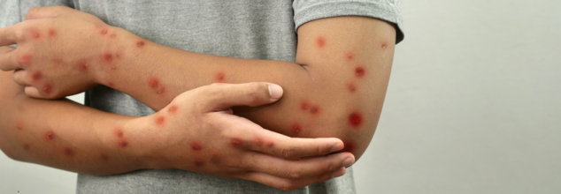 MPOX Still A Public Health Emergency, Says WHO