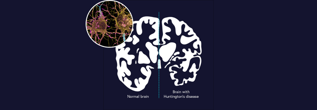 Smartphone Tool Can Now Detect Early Warning Signs Of Huntington’s Disease In 5 Minutes, Finds Study