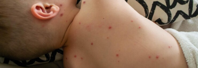 As US Measles Cases Climb To Nearly 1,200, Over 3% Of The Infected Population Were Fully Vaccinated