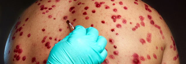 Public Health Warning Issued as Measles Case Hits Sydney