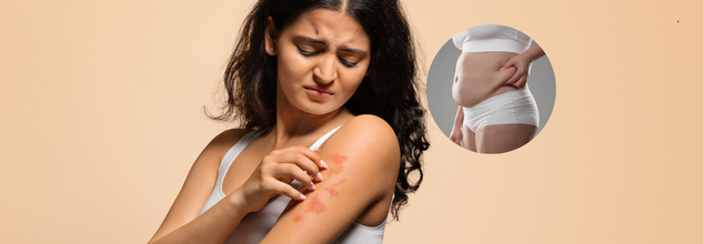 Can Belly Fat Increase The Risk Of Psoriasis? Here's What The Study Says