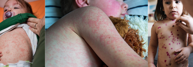Measles Outbreak: North Carolina Confirms Its First Case Of 2025