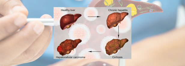 Here's Why Liver Cirrhosis Is Rising, Even Among Non-Drinkers