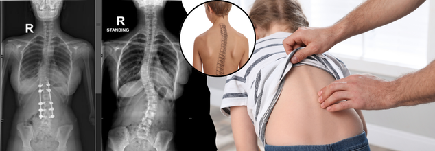 At 13, This Girl Began Walking Like A 90-Year-Old Due To A Spine Condition That Affects 1 In 10 Kids