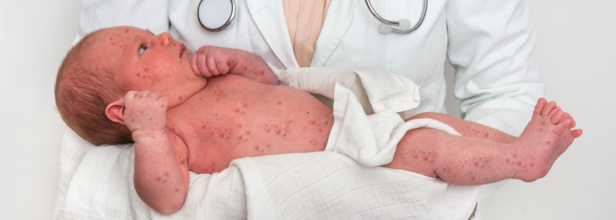Measles Outbreak Update: Kentucky Confirms Its First Case