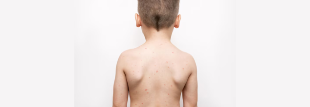 Measles Cases Hit Record Levels—Highest Surge Since US Declared Disease Eliminated; Is This America's Public Health Failure?