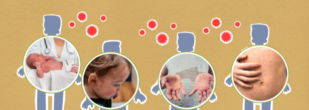 U.S. Measles Cases Surge To Highest Level Since Elimination In 2000
