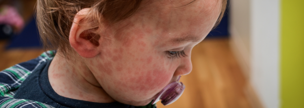 Child Dies Of Measles In UK Hospital As Health Officials Warn Of Rapid Community Spread