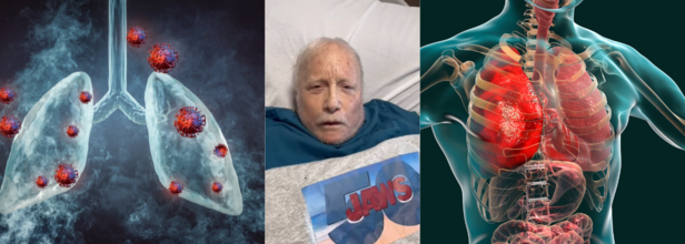 'Jaws' Star Richard Dreyfuss Skips Fan Event After Being Diagnosed With Severe Bronchitis, Know What It Is