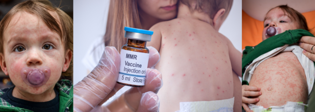 Liverpool Measles Death Alerted Urgency Around Child MMR Vaccines: Here's All That You Need To Know