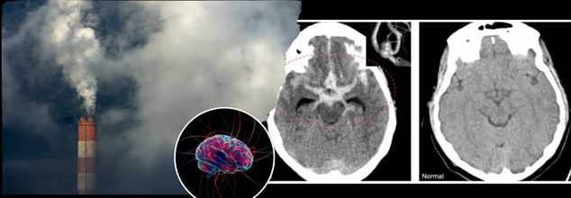 Air Pollution Is Doing More Than Clogging Your Lungs, It Is Now Linked To Brain Tumour