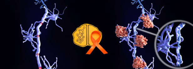 New Oral Treatment Offers Hope For MS Patients Battling Muscle Spasticity