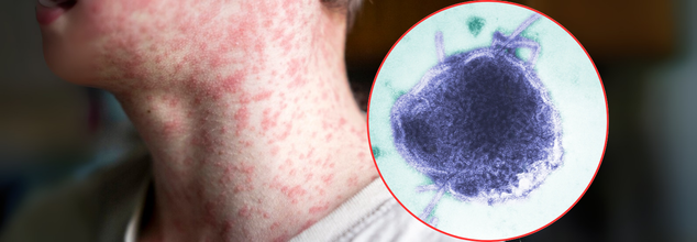 Measles Can Erase Your Immune System’s Memory—Here’s What That Means