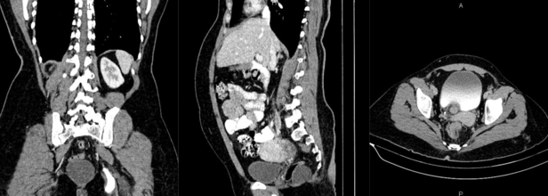How A Painful Discharging Lesion In Back Turned Out To Be a Rare Taligut Cyst