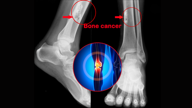 Bone Cancer Awareness Month 2025:  Bone Cancer Isn’t Just an Elderly Disease: When To Suspect A Tumor And Know The Risks At Any Age
