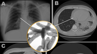Legionnaires Outbreak: All That You Need To Know About The Disease That Killed 1 And Left 22 Sick In New York