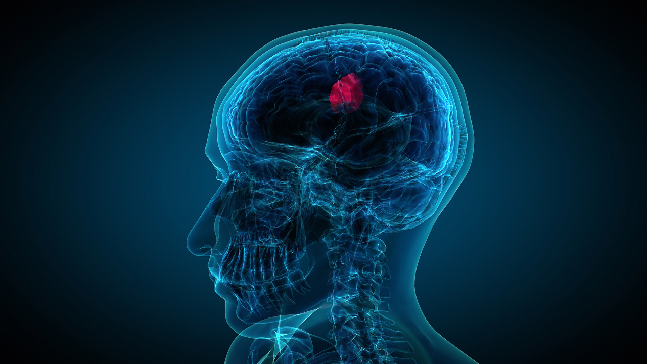 Dizzy Spells Misread as Vertigo Led to Brain Tumour Diagnosis for 63 ...