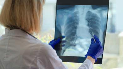 Lung Cancer Prognosis In Women Are Not The Same As Men - Why Are Doctors Are Still Missing The Signs?