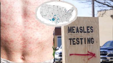 After 212 Days, Has US Lost 'Elimination Status' For Measles As Outbreak Hit A Record High Of 1331 Cases