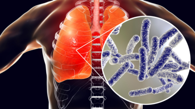 Unique COVID-19 Like Symptoms Of Legionnaires' Disease And How Long Does The Infection Last