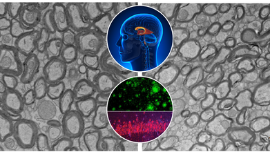 Could Lithium Deficiency In The Brain Trigger Alzheimer’s?