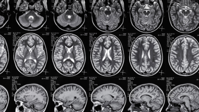 What Causes Epilepsy? 5 Common Reasons Why It Happens