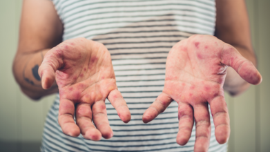 Measles In US: What Is The First Symptom Of Measles And How To Recognize It?