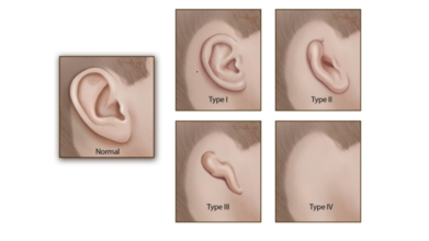 What Happens When You Have "Small Ear"? All That You Need To Know About Microtia