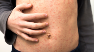 Ottawa Measles Update: Ottawa Public Health Warns Residents Against Measles Amid Its 5th Case