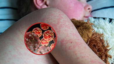 Measles Cases Surge Worldwide, Korean Health Data Flags Countries At Highest Risk For Travellers