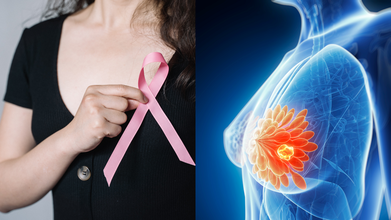 Neoadjuvant Therapy for Breast Cancer