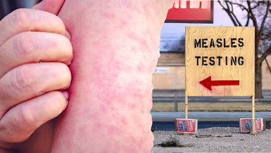 Measles Outbreak Declared Over In Texas After More Than 700 Were Infected, Say Health Officials