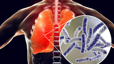 Legionnaires' Outbreak: Death Toll Increases To 6 With 111 Hospitalized, How To Spot The First Symptoms