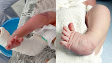 Clubfoot
