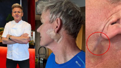 Celebrity Chef Gordon Ramsay Reveals Skin Cancer Diagnosis While Sharing Photo With 'A Line Of Stitches'