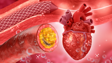 Do You Have A 'Fatty Heart'? Here's How To Tell And Changes That Can Save Your Life