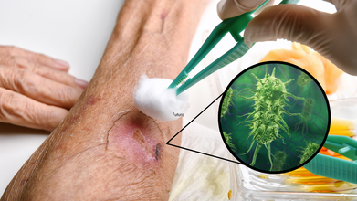 Flesh Eating Bacteria Death Toll At 4 People, 22 Hospitalized, Does It Actually Eat Your Flesh?