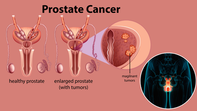 Prostate Cancer Rates Climb Again After A Decade Of Decline: 80% Of Americans Don’t Know Early Stage Disease Has No Symptoms