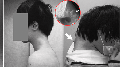 Gamer’s Neck Develops 'Dropped Head Syndrome' After Years Of Looking At His Phone, Doctors Warn Of Debilitating Condition