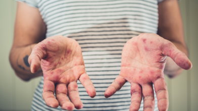 British Tourists Urged to Take This Step Before Travelling as Measles Cases Soar: How To Identify It