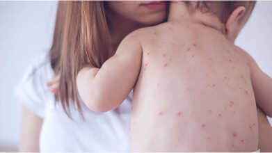 Measles Outbreak Surges Across US